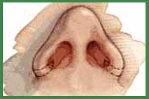 Otoplastica - Orecchie Prominenti
