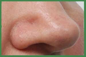 Valvola nasale collossata dopo rinoplastica